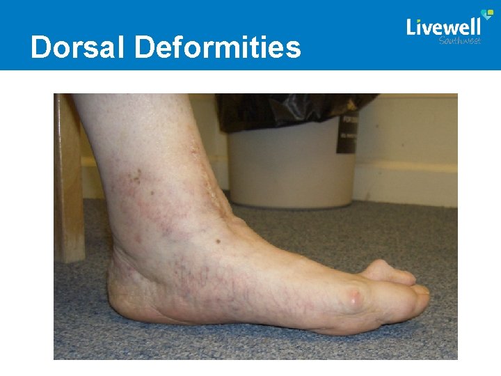 Dorsal Deformities 