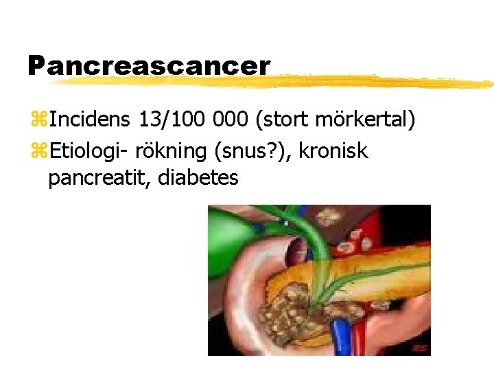 Pancreascancer Incidens 13/100 000 (stort mörkertal) Etiologi- rökning (snus? ), kronisk pancreatit, diabetes 