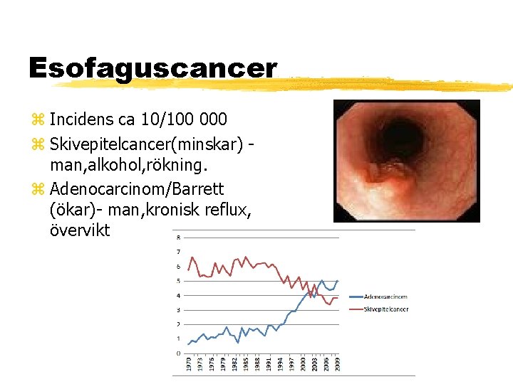 Esofaguscancer Incidens ca 10/100 000 Skivepitelcancer(minskar) man, alkohol, rökning. Adenocarcinom/Barrett (ökar)- man, kronisk reflux,