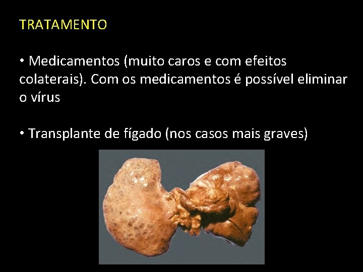 TRATAMENTO • Medicamentos (muito caros e com efeitos colaterais). Com os medicamentos é possível