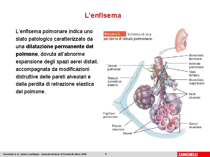 L’enfisema polmonare indica uno stato patologico caratterizzato da una dilatazione permanente del polmone, dovuta