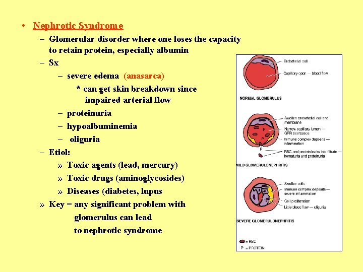  • Nephrotic Syndrome – Glomerular disorder where one loses the capacity to retain