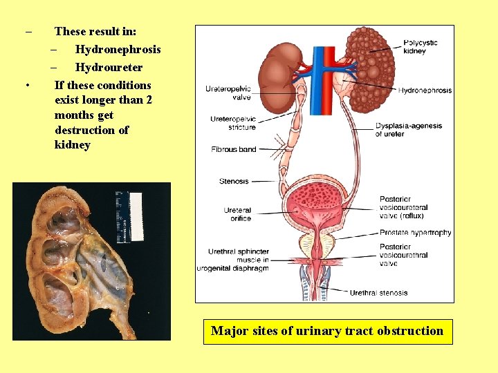 – • These result in: – Hydronephrosis – Hydroureter If these conditions exist longer