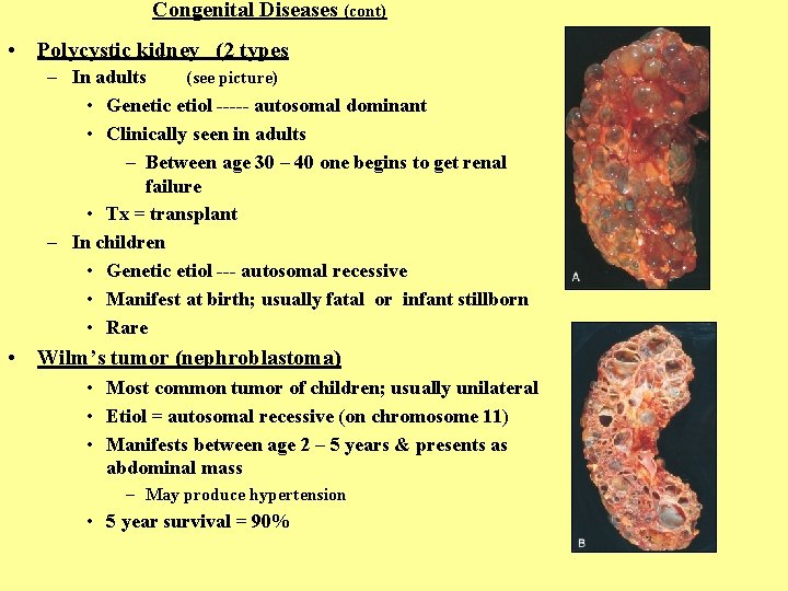 Congenital Diseases (cont) • Polycystic kidney (2 types – In adults (see picture) •