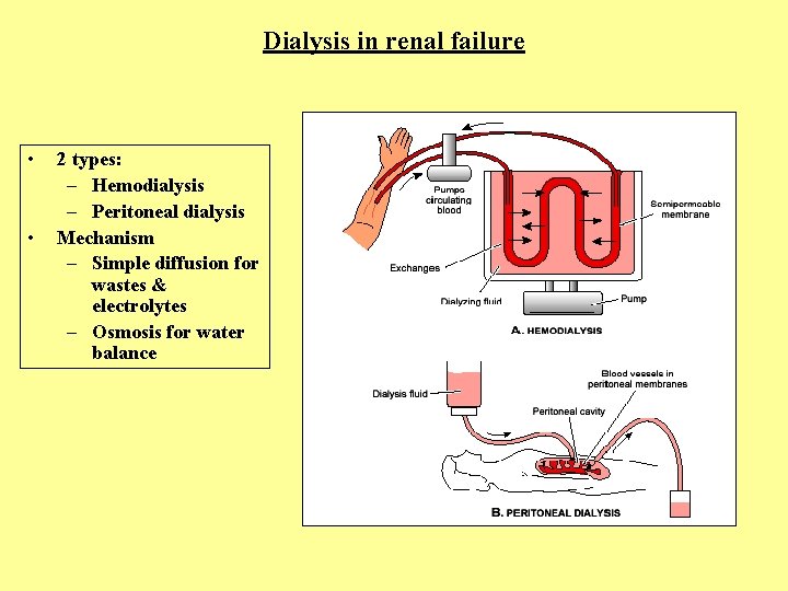 Dialysis in renal failure • • 2 types: – Hemodialysis – Peritoneal dialysis Mechanism