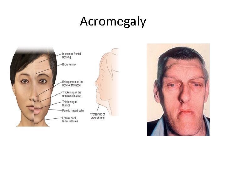 Acromegaly 