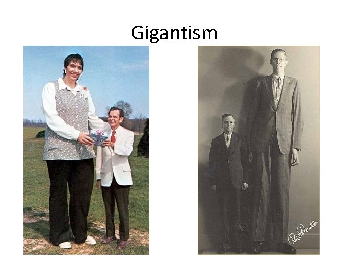 Gigantism 