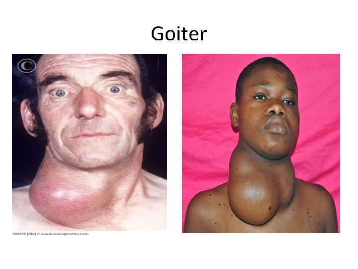 Goiter 