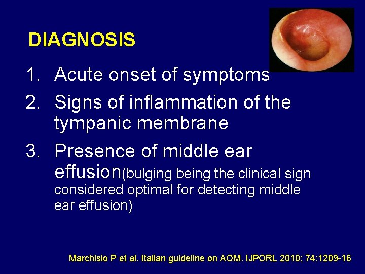 DIAGNOSIS 1. Acute onset of symptoms 2. Signs of inflammation of the tympanic membrane