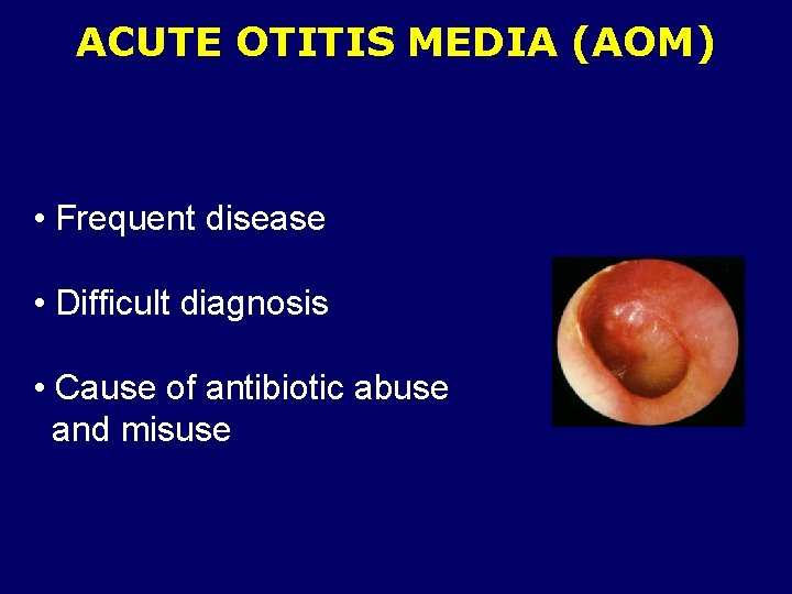 ACUTE OTITIS MEDIA (AOM) • Frequent disease • Difficult diagnosis • Cause of antibiotic