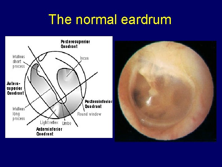 The normal eardrum 