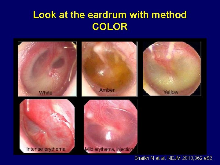Look at the eardrum with method COLOR Shaikh N et al. NEJM 2010; 362: