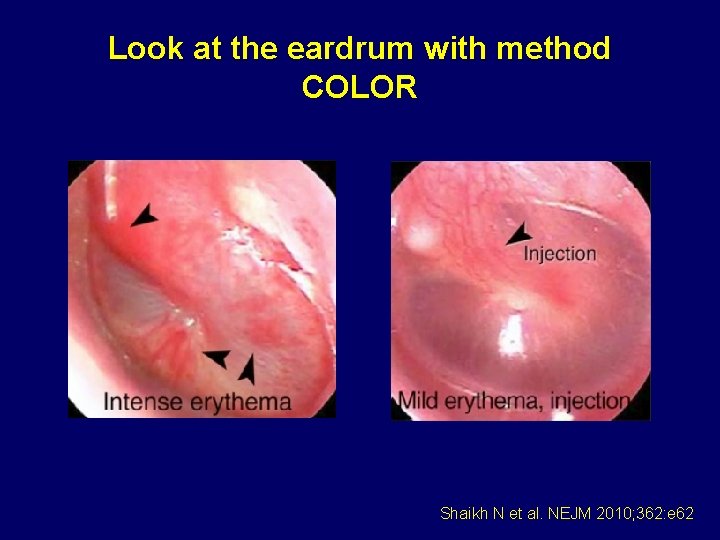 Look at the eardrum with method COLOR Shaikh N et al. NEJM 2010; 362: