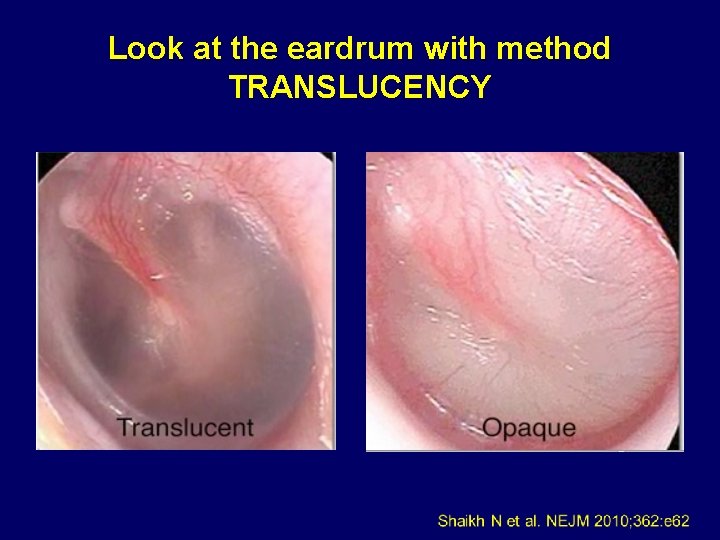 Look at the eardrum with method TRANSLUCENCY 