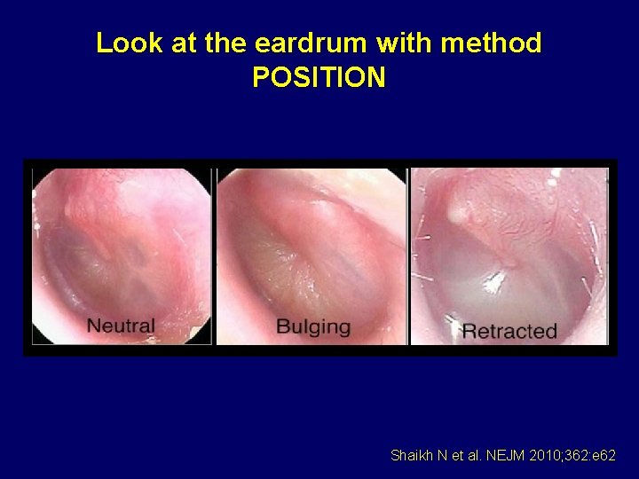 Look at the eardrum with method POSITION Shaikh N et al. NEJM 2010; 362: