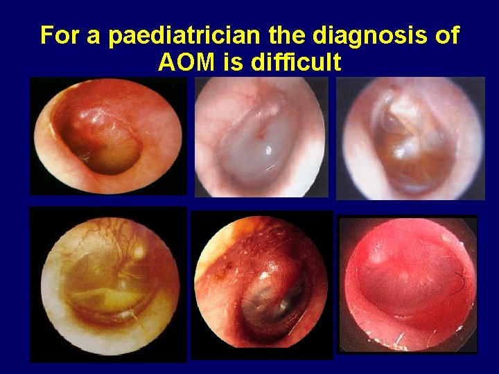 For a paediatrician the diagnosis of AOM is difficult 