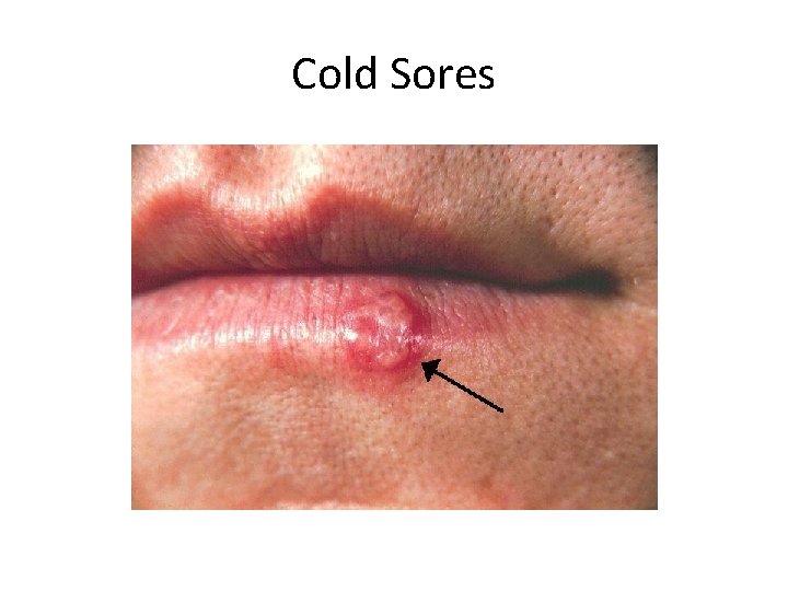 Cold Sores 