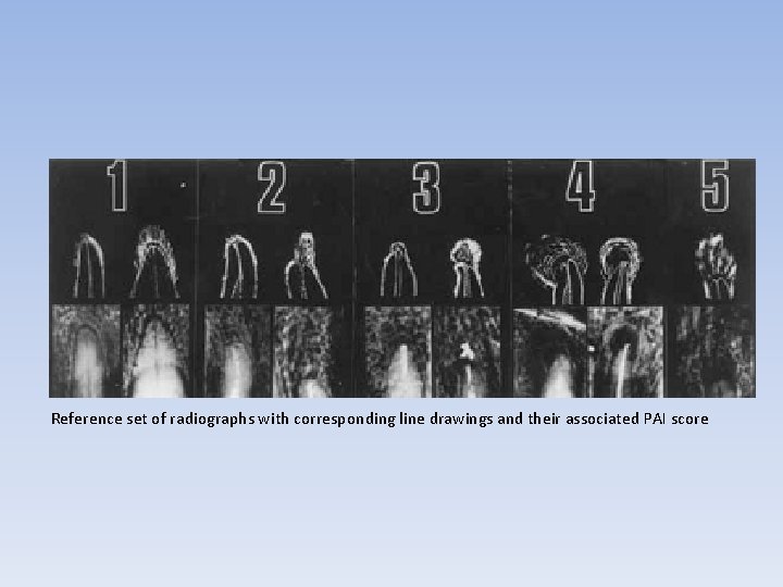 Reference set of radiographs with corresponding line drawings and their associated PAI score 