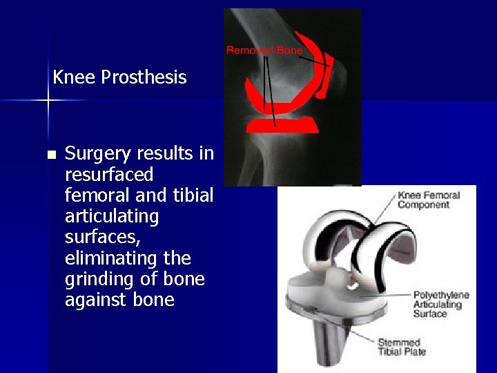 Knee Prosthesis n Surgery results in resurfaced femoral and tibial articulating surfaces, eliminating the