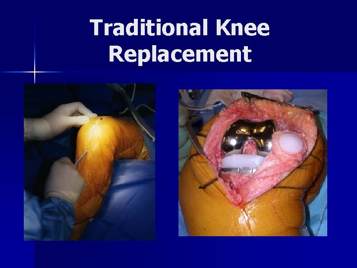 Traditional Knee Replacement 