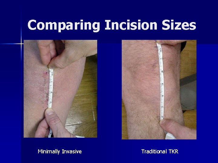 Comparing Incision Sizes Minimally Invasive Traditional TKR 