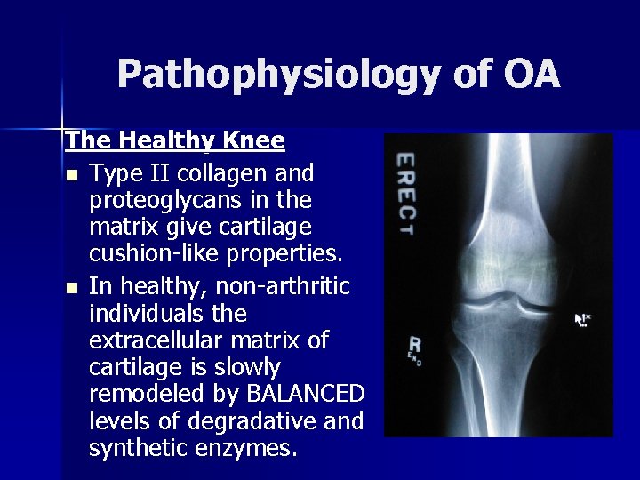 Pathophysiology of OA The Healthy Knee n Type II collagen and proteoglycans in the