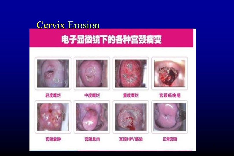 Cervix Erosion 3 