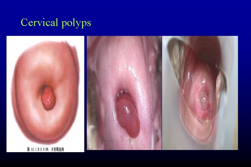 Cervical polyps 7 