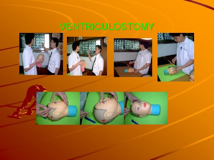 VENTRICULOSTOMY 