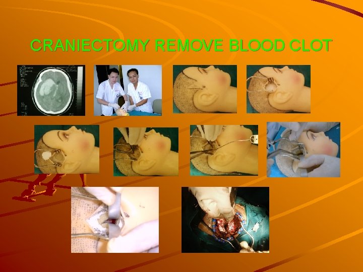 CRANIECTOMY REMOVE BLOOD CLOT 