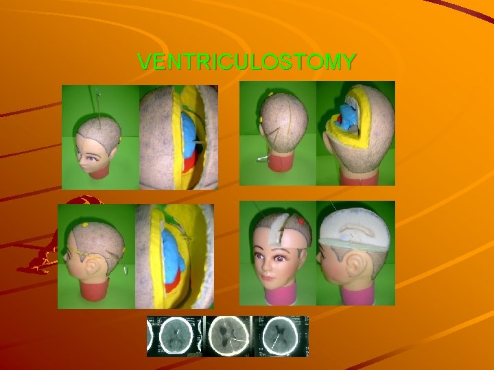 VENTRICULOSTOMY 