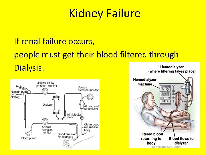 Kidney Failure If renal failure occurs, people must get their blood filtered through Dialysis.