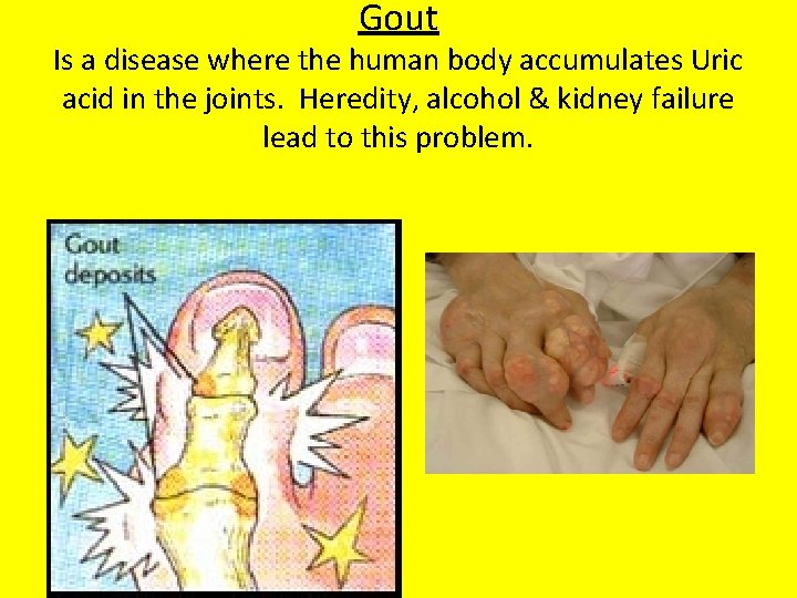 Gout Is a disease where the human body accumulates Uric acid in the joints.