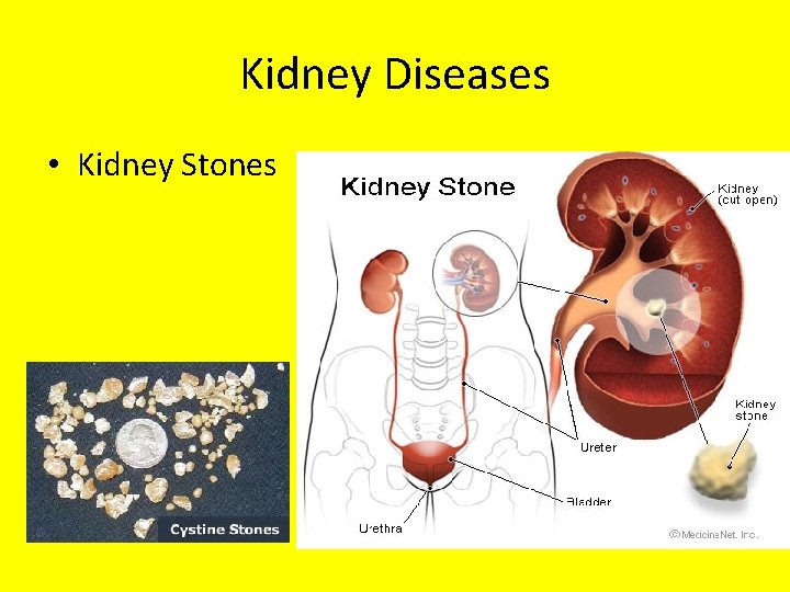 Kidney Diseases • Kidney Stones 