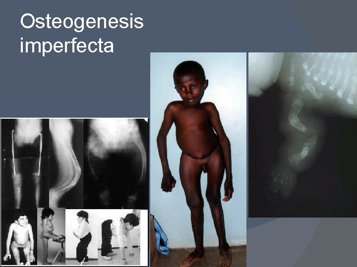 Osteogenesis imperfecta 