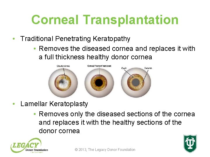 Corneal Transplantation • Traditional Penetrating Keratopathy • Removes the diseased cornea and replaces it