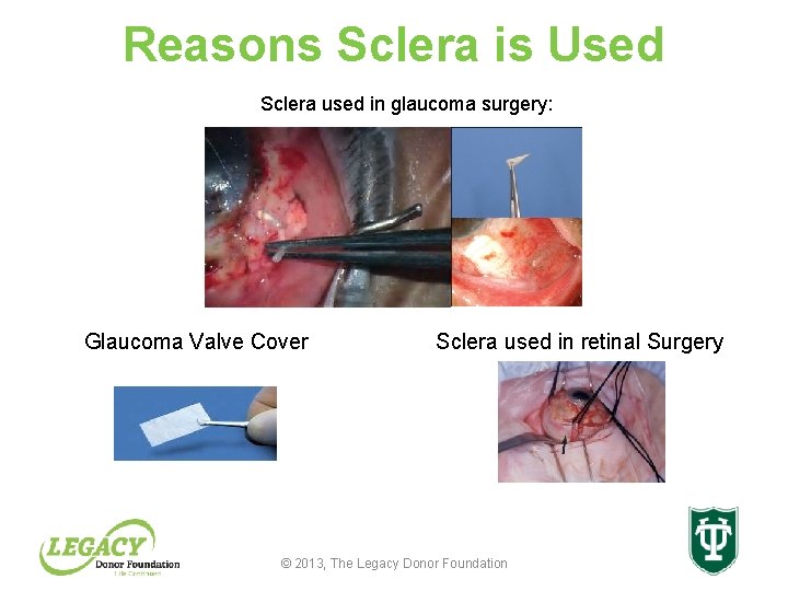 Reasons Sclera is Used Sclera used in glaucoma surgery: Glaucoma Valve Cover Sclera used