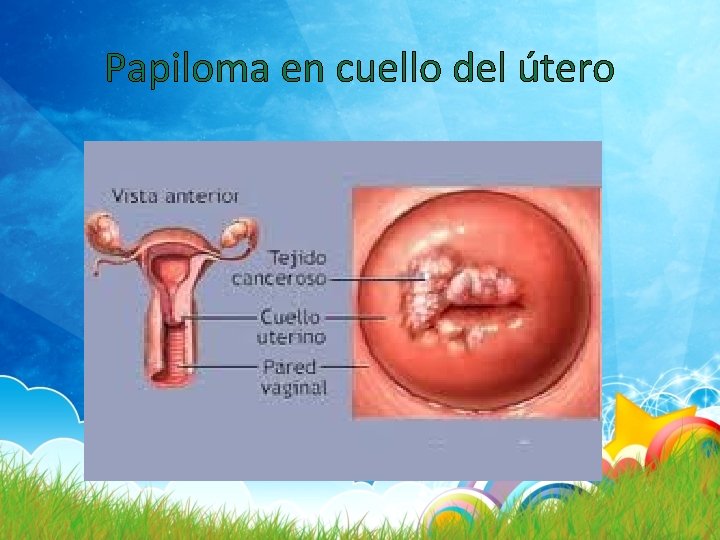 Papiloma en cuello del útero 