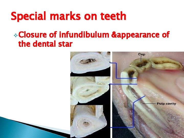Special marks on teeth v Closure of infundibulum &appearance of the dental star 