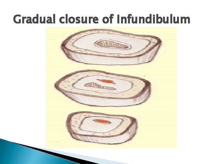 Gradual closure of Infundibulum 