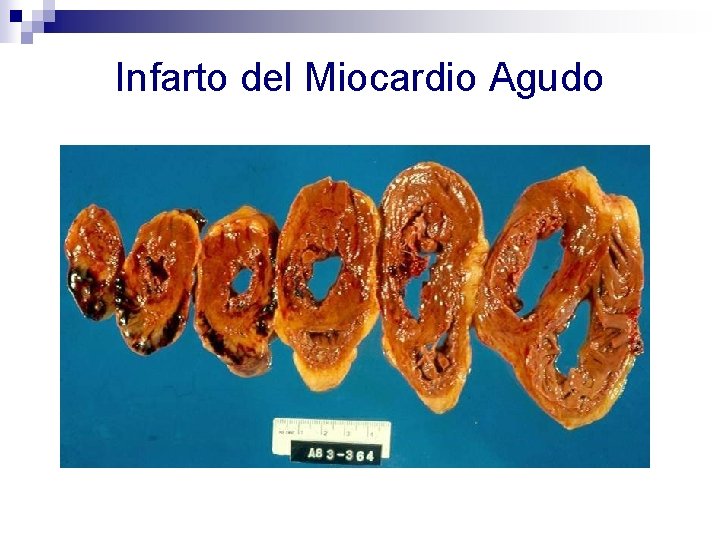 Infarto del Miocardio Agudo 