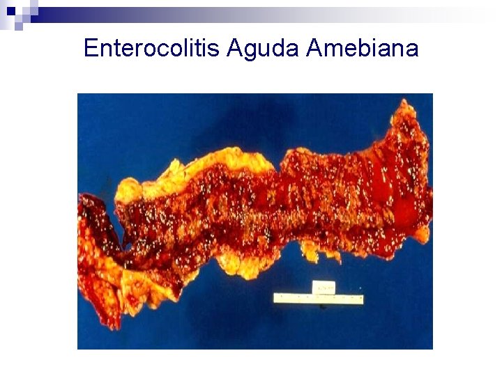 Enterocolitis Aguda Amebiana 