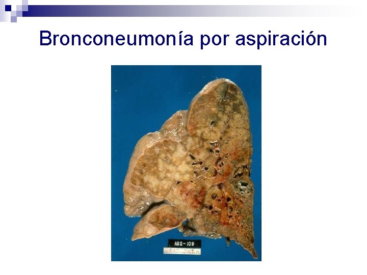 Bronconeumonía por aspiración 