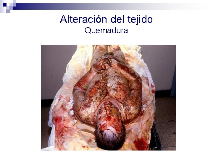 Alteración del tejido Quemadura 