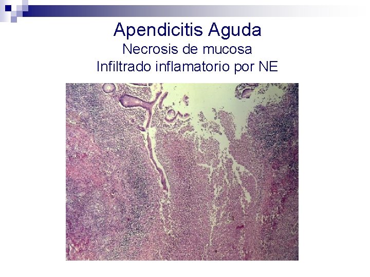 Apendicitis Aguda Necrosis de mucosa Infiltrado inflamatorio por NE 