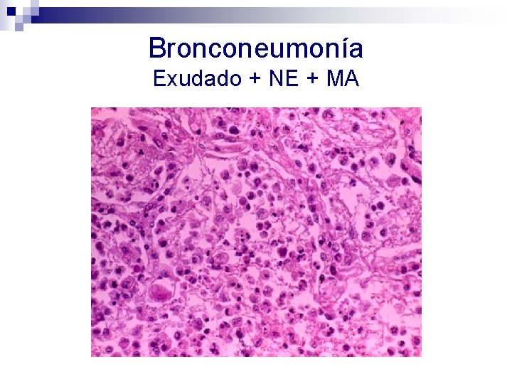 Bronconeumonía Exudado + NE + MA 