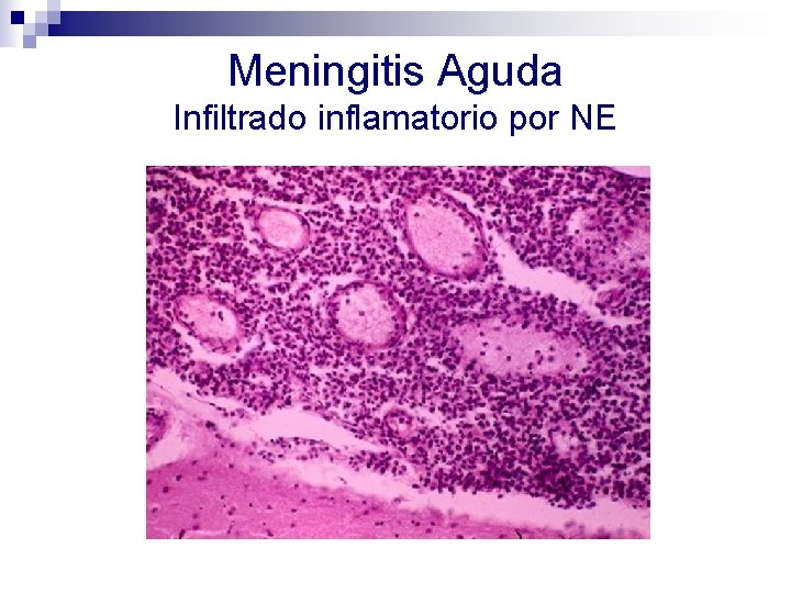 Meningitis Aguda Infiltrado inflamatorio por NE 