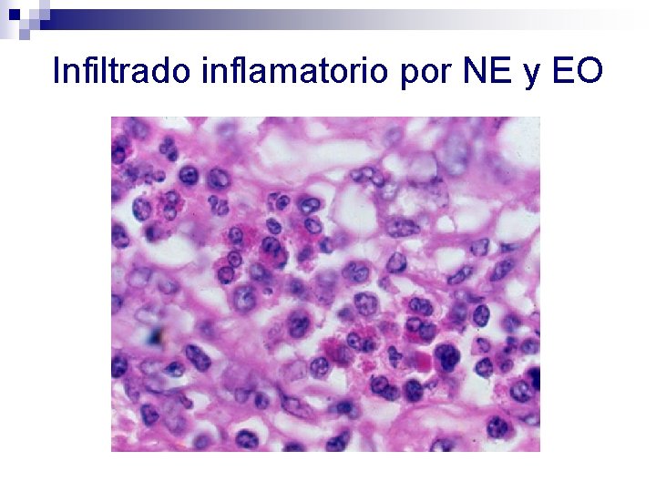 Infiltrado inflamatorio por NE y EO 