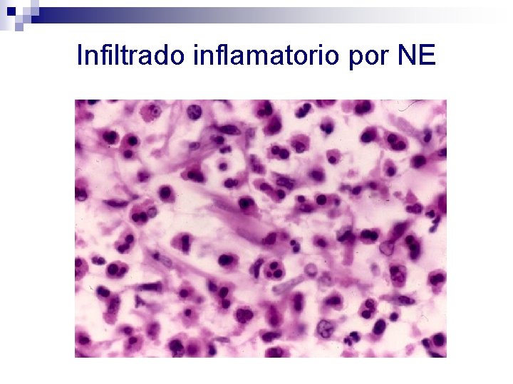 Infiltrado inflamatorio por NE 