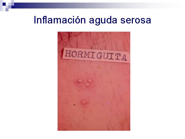 Inflamación aguda serosa 